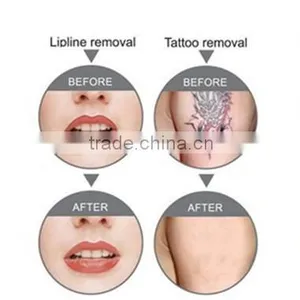 SUS Fda Approved Tattoo Removal Lasers nd Yag Laser Tattoo Removal thumbnail-5