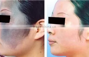 532nm China Produced Q Switch Nd Yag Laser Machine With 1064nm And 532nm And Black Doll Head 800mj thumbnail-6