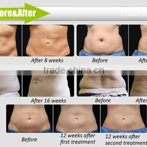 Hot Sale Freezing Fat Slimming Machine Medical thumbnail-6