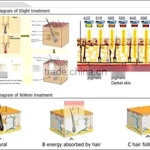 Safe and Good Effect Personal Hair Removal Machine for Sale thumbnail-3