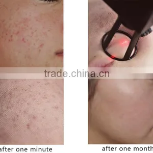 Eliminate Body Odor Medical Equipment Scar Removal CO2 Laser 480-1200nm 40w Skin Renew Fractional Spot Scar Pigment Removal Pigment Removal thumbnail-6