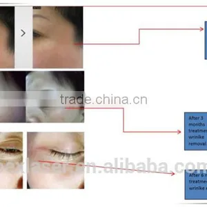 Eye Wrinkle Treatment RF Eye Lift Machine thumbnail-6