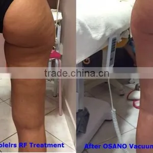 Professional Anti Cellulite Therapy Vacuum Roller Cellulite Machine thumbnail-6