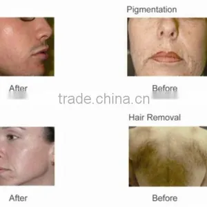 Med.apolo HS-665 Elight(IPL + RF) Laser Hair Removal Beauty Machine thumbnail-4