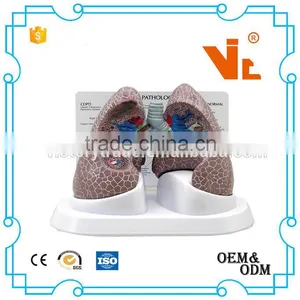 V-AM032 Plastic Diseased Teaching Lung Model thumbnail-1