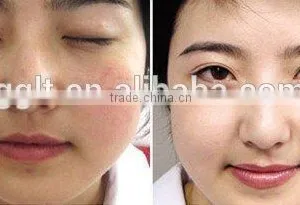 Good Effects Wholesale Vascular Remover 980nm Spider Vein Removal Machine thumbnail-5