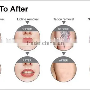 2016 Medical CE Approved Ipl, Ipl Home Laser Pigmentation, Home Ipl thumbnail-3
