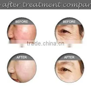 2015 Hot New Products! Beauty Salon Use IPL Permanent Hair Removal Machine thumbnail-6