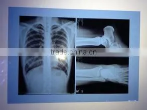 Medical X-ray Film Agfa Medical Dry Film for X-ray Machine Agfa Kodak Film thumbnail-4