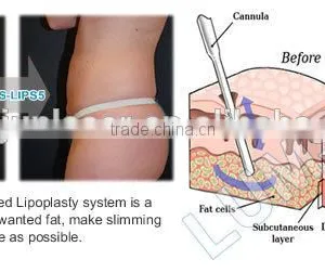 Surgical Liposuction Machine PAL Liposuction thumbnail-5