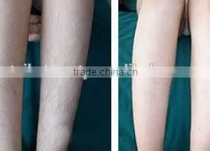 530-1200nm 2016 Best Ipl Photofacial Machine For Medical Home/portable Ipl Hair Removal Machine No Pain thumbnail-6