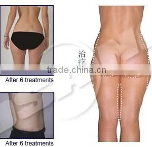 Liposuction Ultrasonic Cavitation Fat Dissolving Machine thumbnail-6