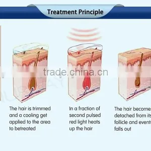 Back / Whisker 2017 Soprano Diode 1-800ms Laser Skin Hair Removal AC220V/110V Pain-Free thumbnail-6