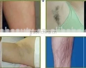 Factory Offer Medical Equipment Laser Therapy for Hair Removal, 808nm Diode Laser Beauty Equipment thumbnail-6