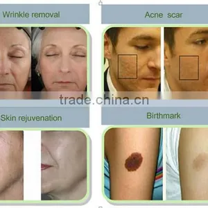 RF Co2 Fractional Laser Face Whitening Equipment To Treat Scar Removal thumbnail-6