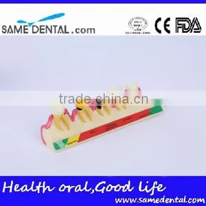 2x Periodontal Disease Classification Models Dental Eduction Assitant No. DEA-20 thumbnail-1