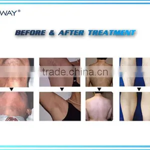 Popular!!! Guarantee 20 Million Flashes Spa Use 808nm Diode Laser Machine for Hair Removal thumbnail-4