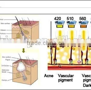 Ipl Hair Removal for Blond Red and Grey Hair thumbnail-3