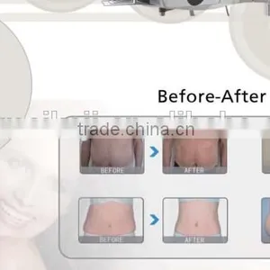 Lipolaser Slimming Machine Loss Weight and Cavitation Machine thumbnail-3