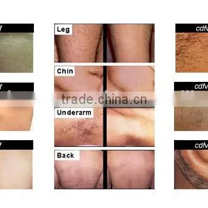 European 808nm Diode Laser! High Energy Dilas Laser Hair Removal thumbnail-6