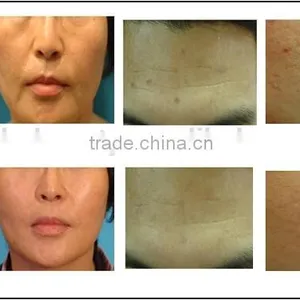 RF Fractional rf Wrinkle Removal and Skin Rejuvenation/Micro Needle rf Needle Machine thumbnail-6