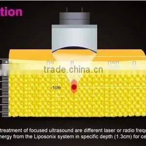 Liposonix Weight Loss Slimming Machine for Beauty Salon Use thumbnail-5
