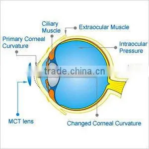 For Low Myopia/MCT Lenses/MCT Technology Hard Contact Lenses thumbnail-1