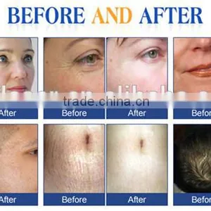 Microneedling Dermaroller 540 Titanium Needles thumbnail-5