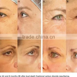 Sanhe Fractional Laser Co2 Skin Tightening System/ Co2 Glass Laser Tube thumbnail-6