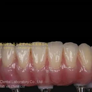 Dental Implant Prosthesis, Implant Denture, Dental Prosthesis, Laboratoire Dentaire, Dentallabor, Laboratorio Dental, Dental Laboratory, Shenzhen LJ Dental Lab China thumbnail-2