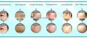 Acne Removal Stationary Ipl Shr Vertical /ipl Shr Machine/ipl Shr For Salon thumbnail-5