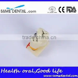 Dental Model School Teaching Dental Eduction Assitant No. DEA-15 4 Times Integrated Pathology Model thumbnail-1