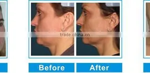 High Intensity Focused Ultrasound High Quality Portable Hifu Laser Machine /laser Hifu Skin Lift Nasolabial Folds Removal thumbnail-6