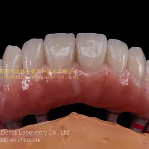 Dental Implant Prosthesis, Implant Denture, Dental Prosthesis, Laboratoire Dentaire, Dentallabor, Laboratorio Dental, Dental Laboratory, Shenzhen LJ Dental Lab China thumbnail-3
