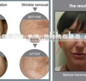 Red Light Therapy For Wrinkles Professional Suslaser PDT Red Led Light Therapy Machine Improve fine lines thumbnail-6