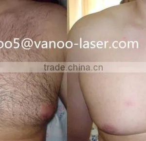 Vascular Treatment 2015 Newest Ipl Skin 10MHz Rejuvenation Machine Home Use Bikini Hair Removal thumbnail-5