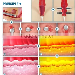 Skin Regeneration Co2 Fractional Rf Birth Mark Removal Vaginal 0.1-2.6mm Tightening Co2 Laser Surgery Machine Tattoo /lip Line Removal thumbnail-6