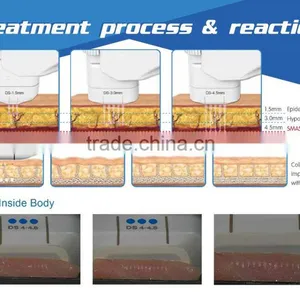 Permanent Face Lift Treatment No Pain Focused Portable Hifu Machine Eye Lines Removal thumbnail-4