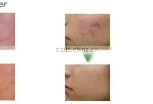 Medical Use CO2 Fractional Laser Scar Removal/fractional Co2 Laser in Dermatology thumbnail-4