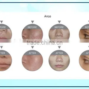 CO2 Fractional Laser Machine Scar And Birth Mark Removal Acne Removal In Beatuty Equipment Carboxytherapy thumbnail-6