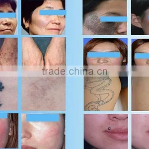 Q-switch Nd Yag Laser Skin Rejuvenation Mongolian Spots Removal Tatoo Removal Machine With CE From Sanhe Haemangioma Treatment thumbnail-6
