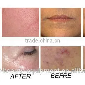 10600nm Safe And No Effect Co2 Fractional Vagina Cleaning Laser Pigment Removal Skin Nurse Machine thumbnail-5