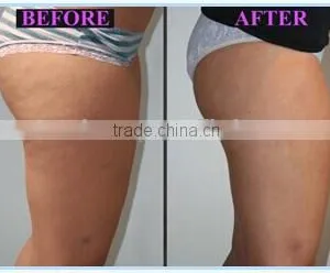 Cool Body Sculpting Criolipolysis Weight Loss Machine With 3 Cryo Handles thumbnail-5