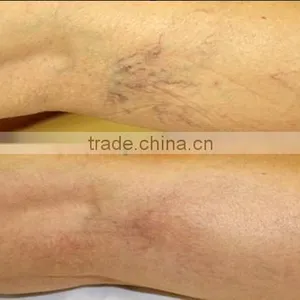 Factory Direct Sale CE Approved Best-selling Home Mini Laser Hair Removal Machine thumbnail-3