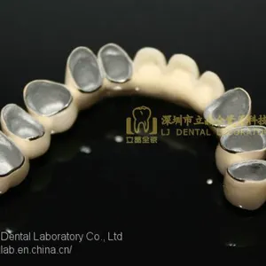 Dental Crown Porcelain Fused Metal, PFM, VMK, Dental Prostheses, Laboratoire Dentaire, Dentallabor, Laboratorio Dental, Dental Laboratory, Shenzhen LJ Dental Lab China thumbnail-3
