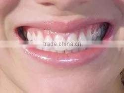 Teeth Whitening thumbnail-1