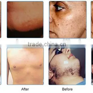 Factory Supplier!!!Professional IPL Laser Skin Rejuvenation / IPL Hair Removal Machine thumbnail-6