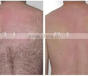 Multifunction Portable Ipl Shr Breast Lifting Up Laser Hair Removal Machine thumbnail-3