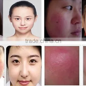 EVLT Laser Spider Vein Removal 980 nm Diode Laser for Whole Body Vascular Lesion Removal thumbnail-6