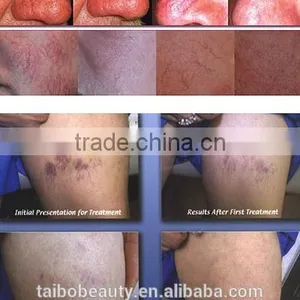 High Frequency RBS Vascular Removal/red Blood Silk Removal/thread Vein Removal Device thumbnail-5